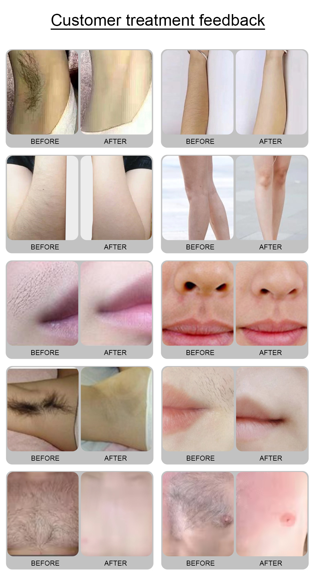 portable diode laser hair removal