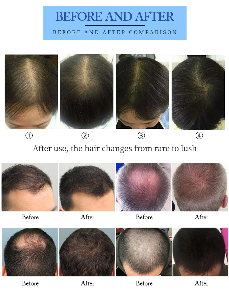 650nm diode laser hair regrowth