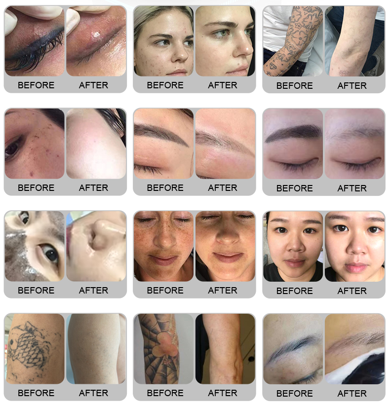  tattoo removal 1064nm 755nm carbon peeling