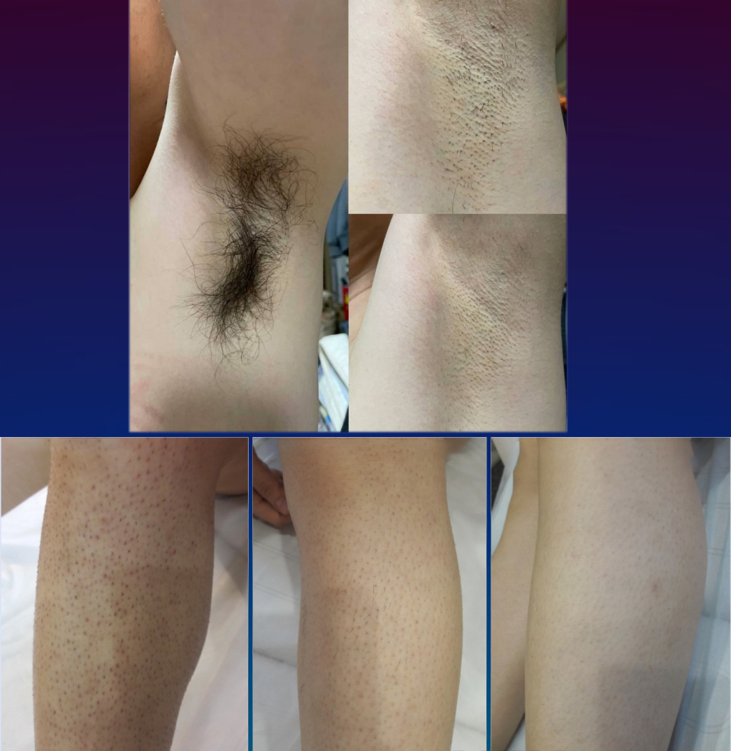 808nm hair removal 