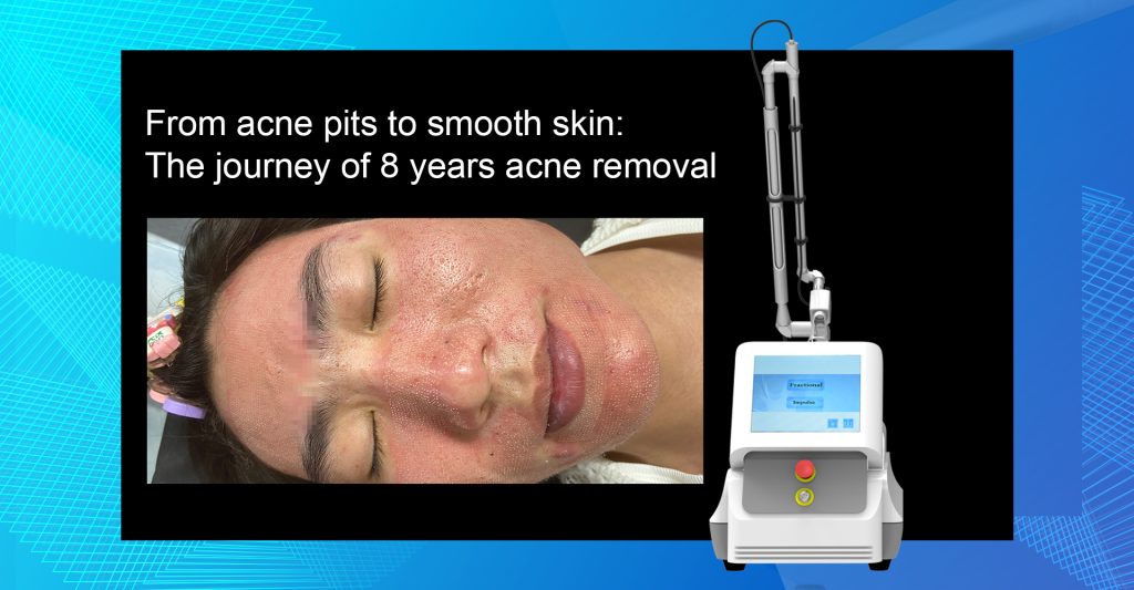 From acne pits to smooth skin: The journey of 8 years acne removal