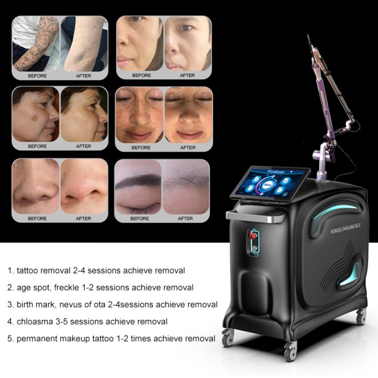 Tattoo Removal Machine