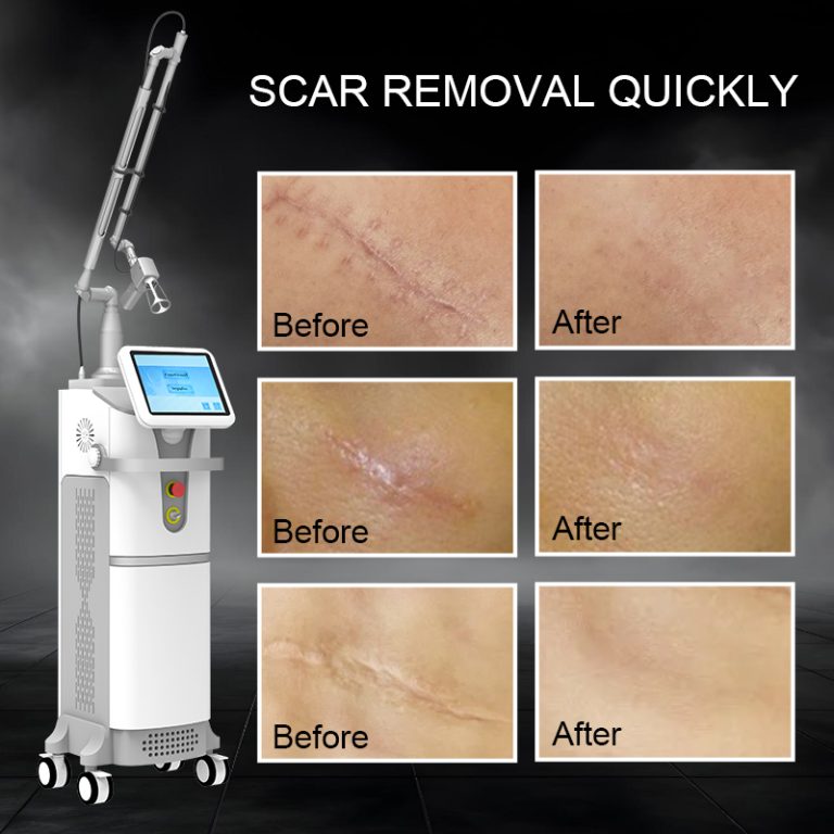 fractional co2 laser skin resurfacing machine